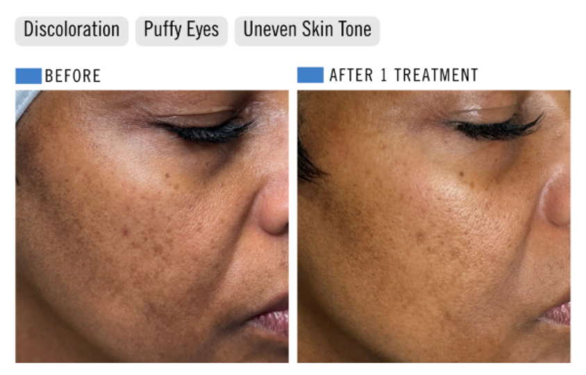 The Healthy Summer Peel