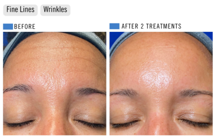 The Healthy Summer Peel