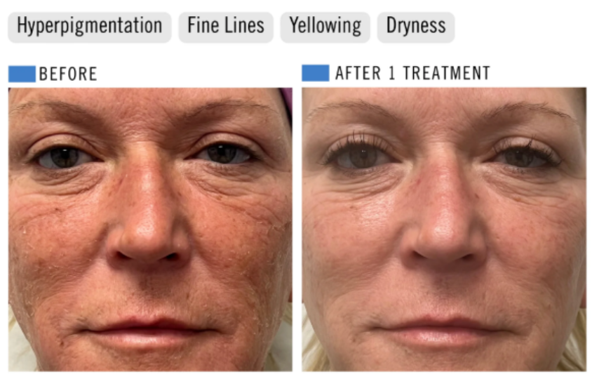 The Healthy Summer Peel