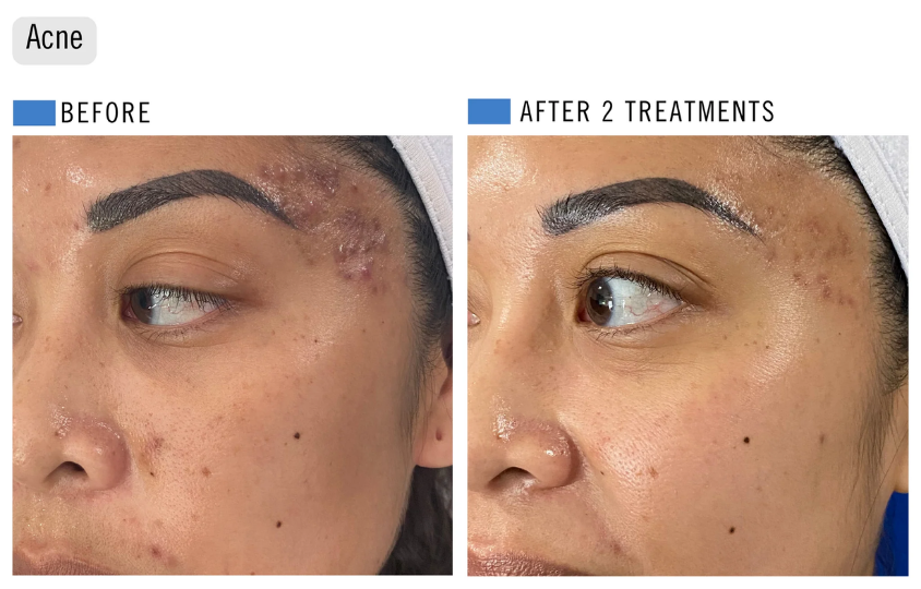 The Healthy Summer Peel