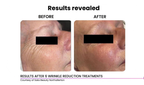 Venus Skin Tightening (Eyes/Face)