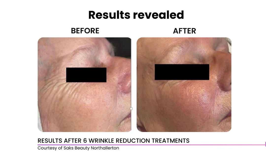 Venus Skin Tightening (Eyes/Face)