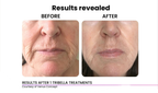 Venus Skin Tightening (Eyes/Face)