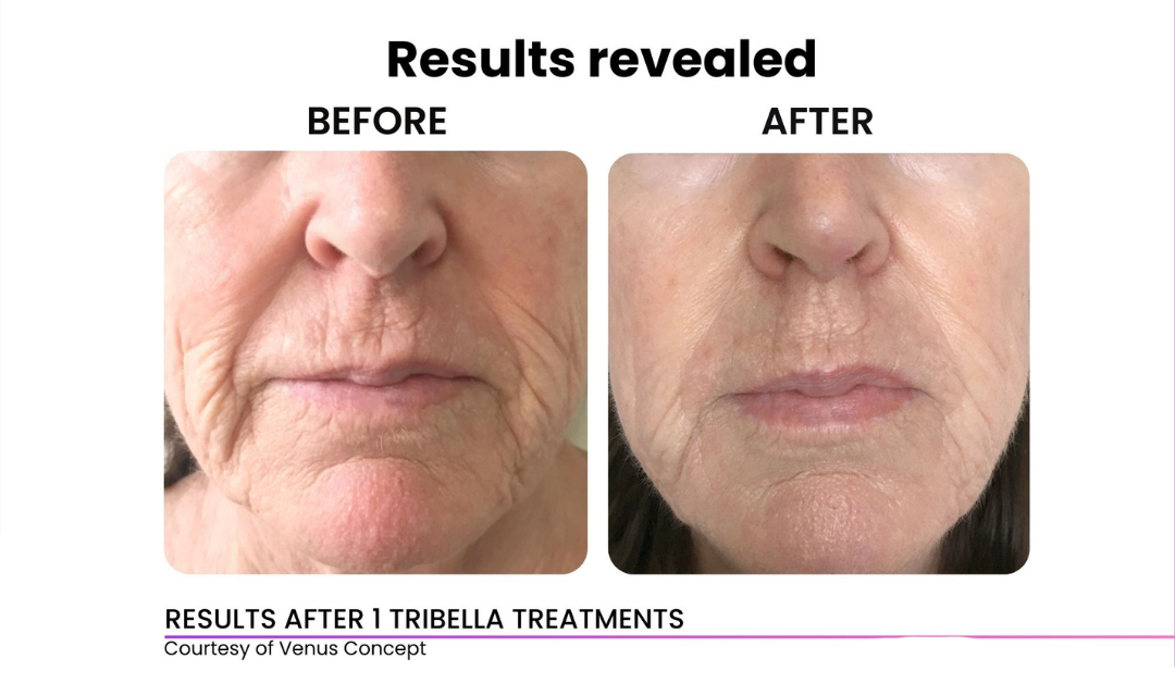 Venus Skin Tightening (Eyes/Face)