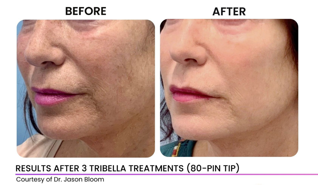 Venus Skin Tightening (Eyes/Face)