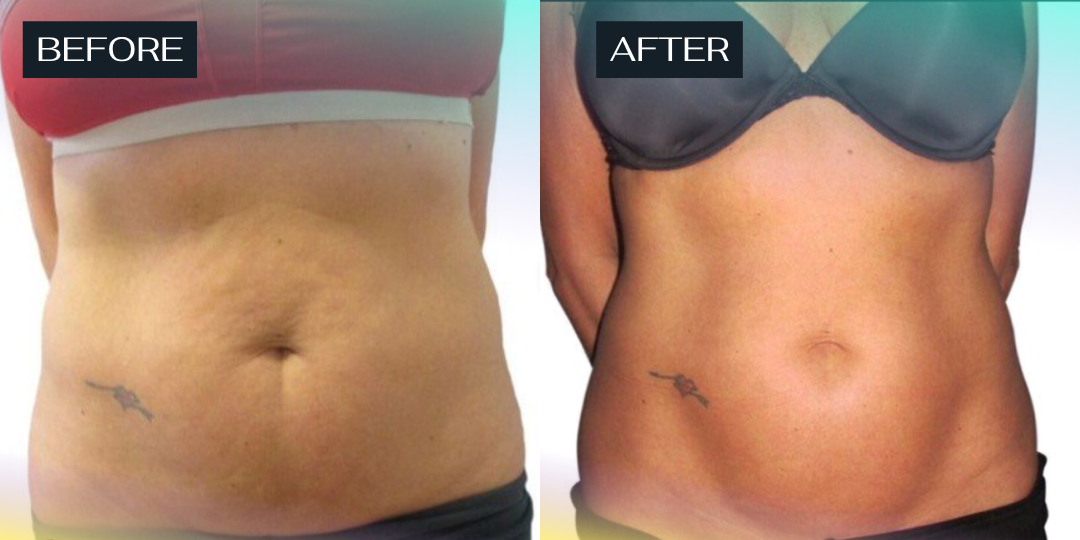 Secret Sale - Venus Body - 3 Treatments