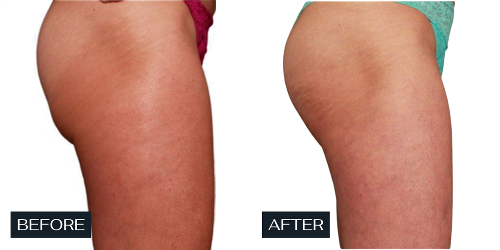 Secret Sale - Venus Body - 3 Treatments