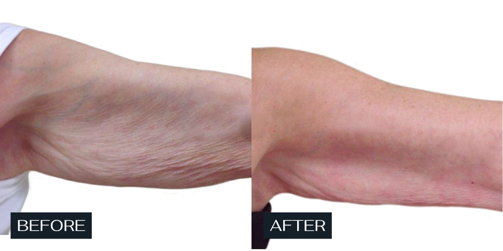 Secret Sale - Venus Body - 3 Treatments