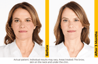 Ultherapy PRIME — New Platform Pricing