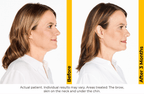 Ultherapy PRIME — New Platform Pricing