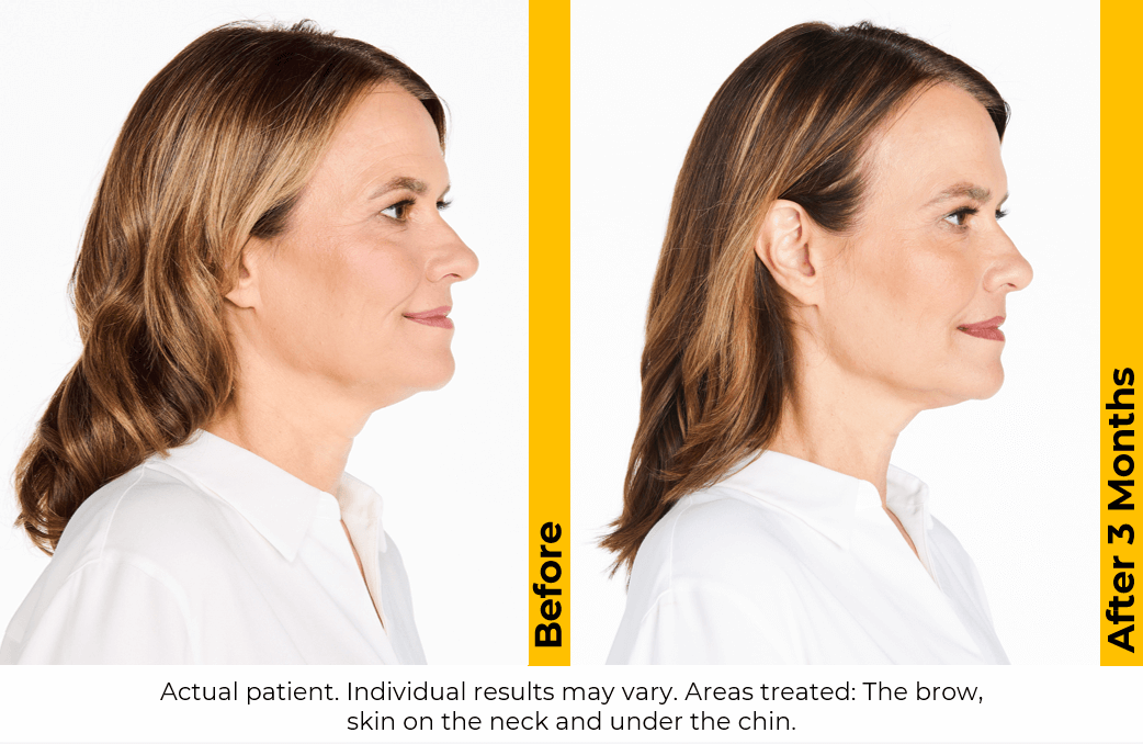 Ultherapy PRIME — New Platform Pricing