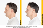 Ultherapy PRIME — New Platform Pricing