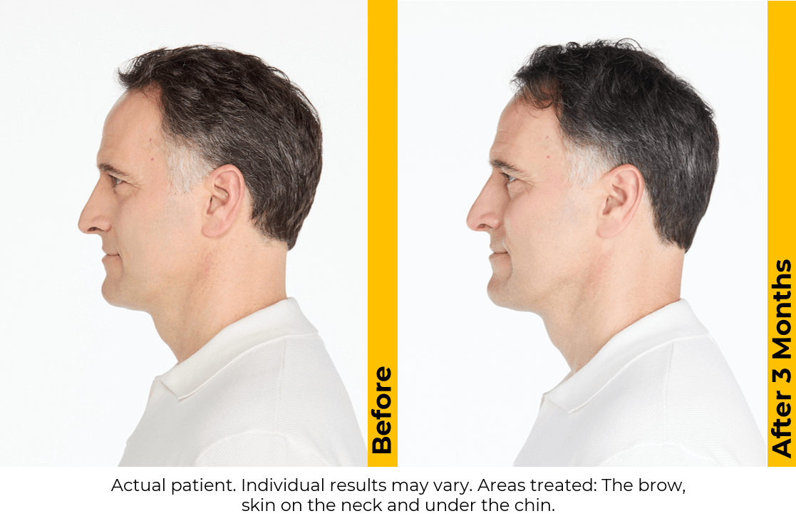 Ultherapy PRIME — New Platform Pricing